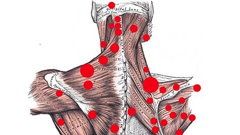Punti trigger nei muscoli che causano mal di schiena miofasciale