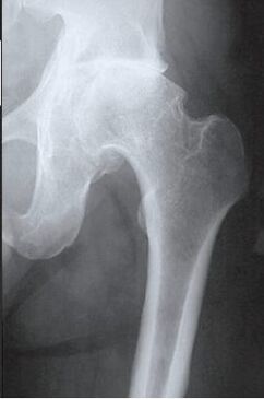 Scansione MRI dell'articolazione dell'anca colpita