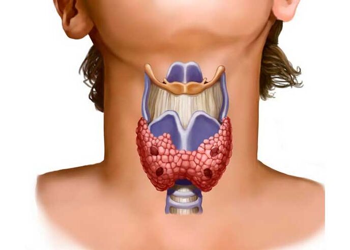 Problemi alla tiroide come causa del dolore al collo