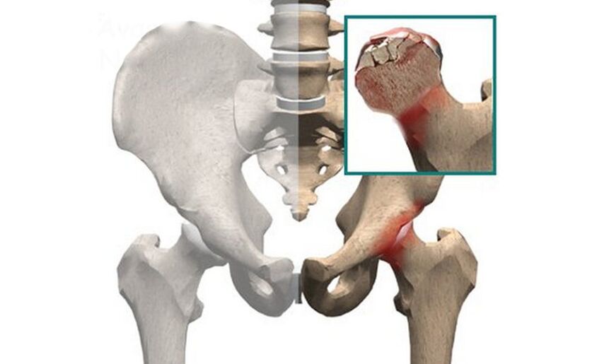 La necrosi della testa del femore è una delle cause del dolore all'articolazione dell'anca