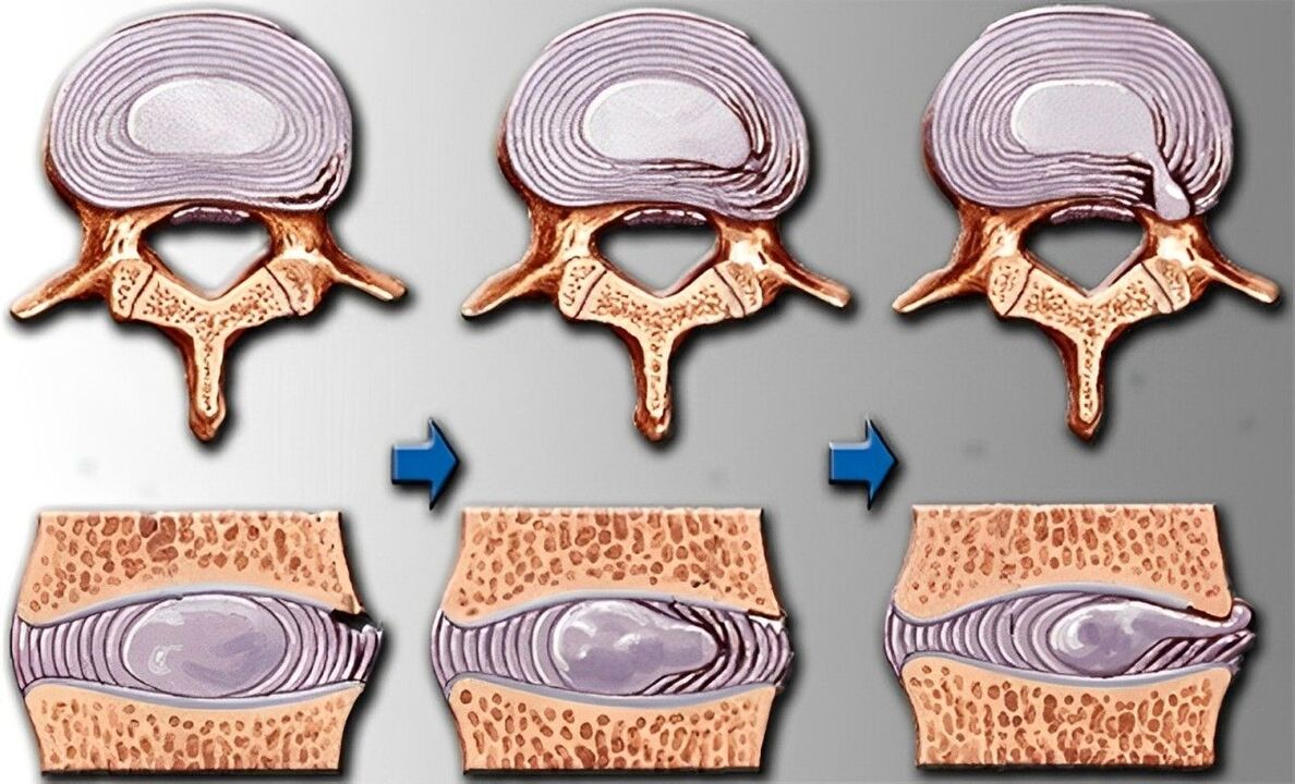 Fasi dell'osteocondrosi