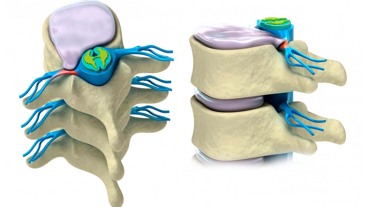 disco intervertebrale danneggiato