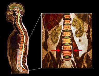 disco intervertebrale degenerativo nella colonna vertebrale