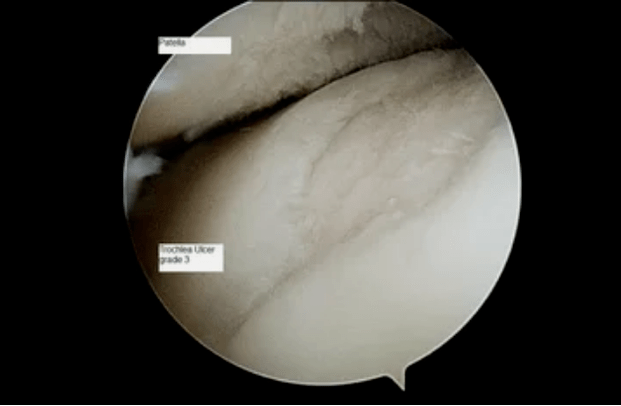 Vista astroscopica di un'articolazione del ginocchio con osteoartrosi di grado 3